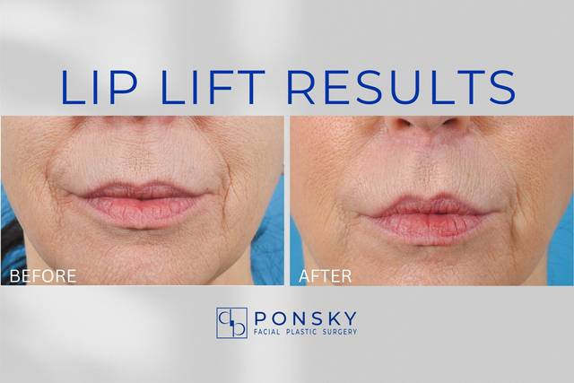 Lip Lift Results