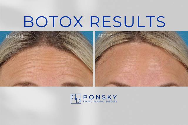 Botox Results