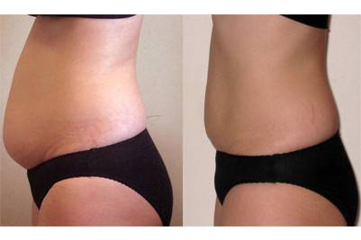 Lose Weight