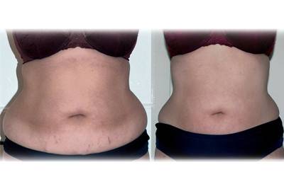 Lose weight