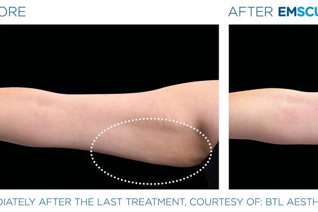 Arm Reduction and Tone