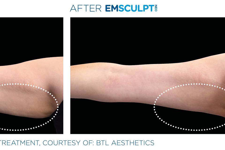 Arm Reduction and Tone