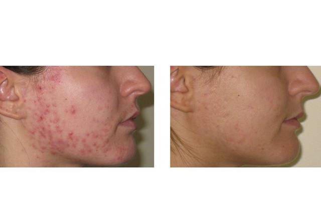 Before & After Advanced Nutrition Programme Skin Accumax