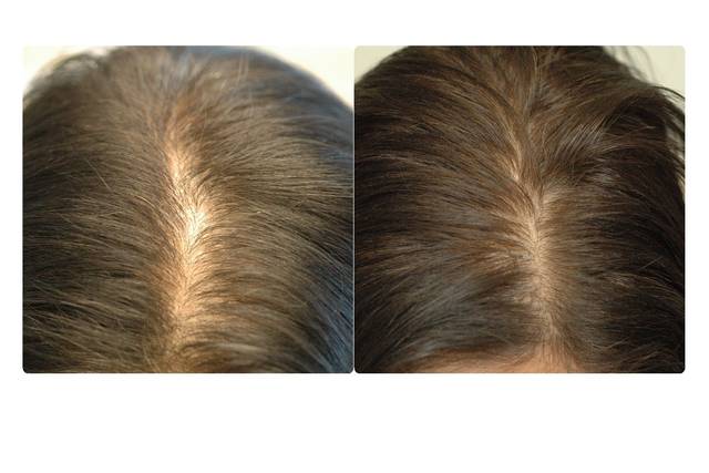 Before & After PRP Treatment to the Scalp