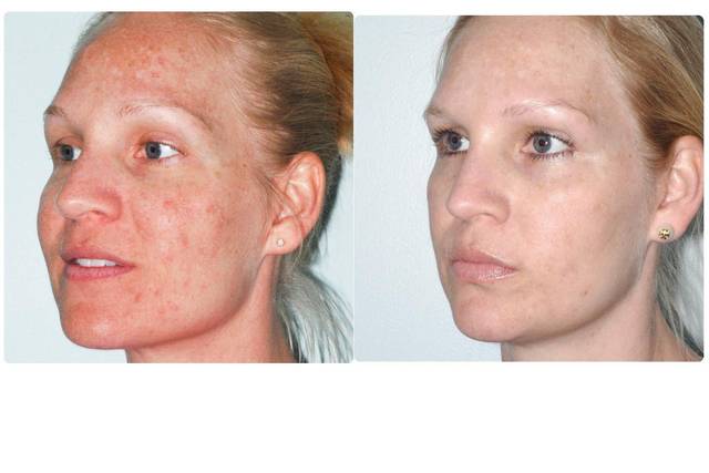 Before & After Photofacial and Light Chemical Peel