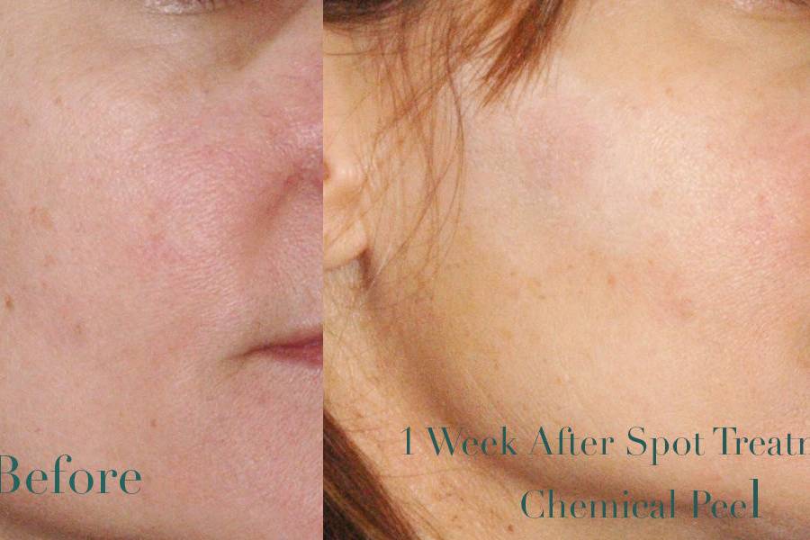 Before & After Chemical Peel Spot Treatment