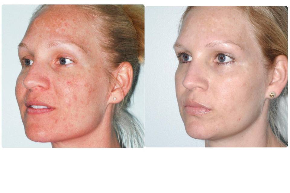 Before & After Photofacial and Light Chemical Peel