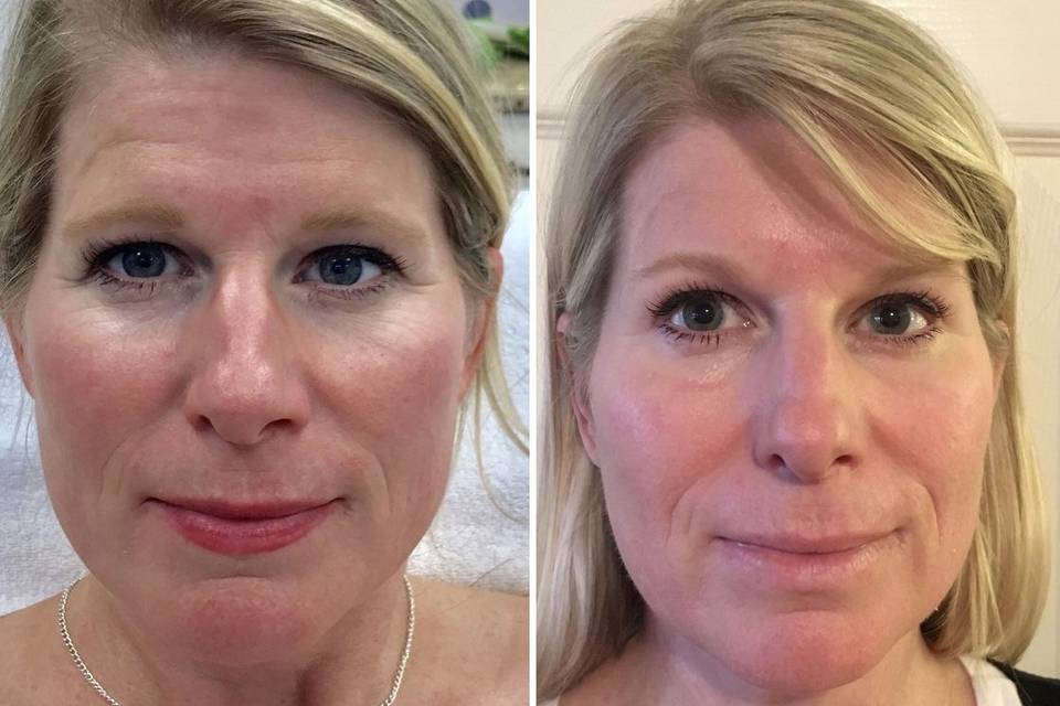 Before and 1 Week After Microneedling & Botox
