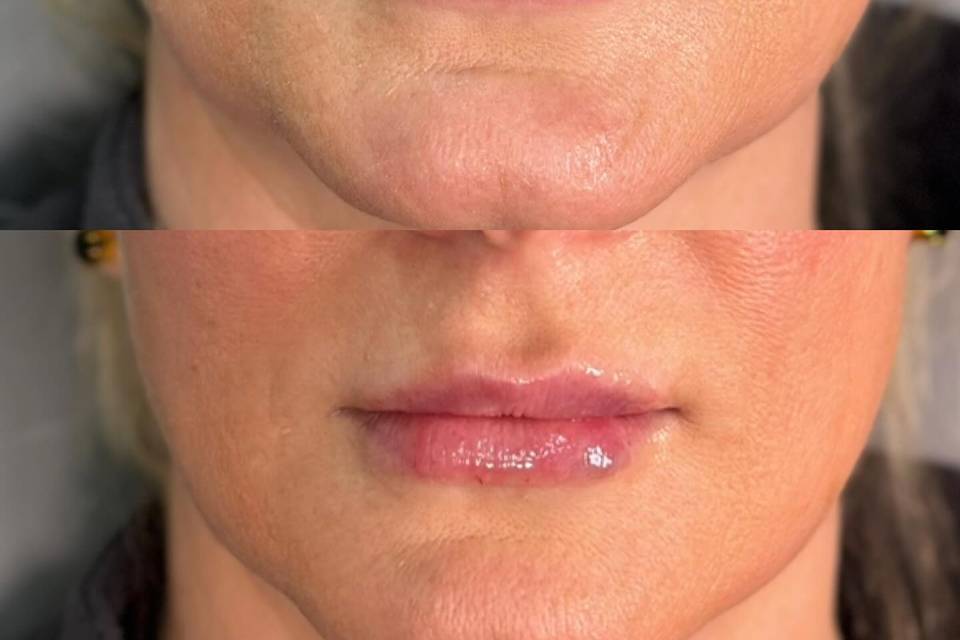 Before and After: Lip Filler