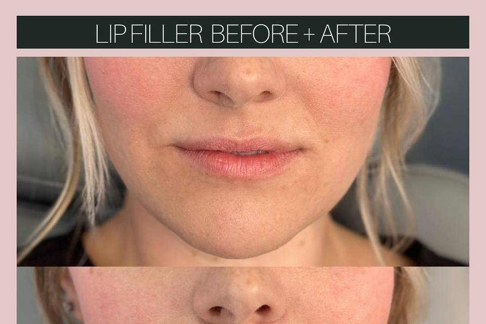 Before and after Lip Filler