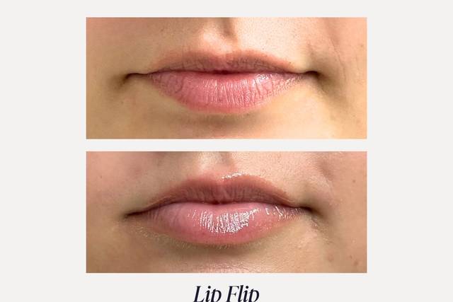 Lip Flip B&A