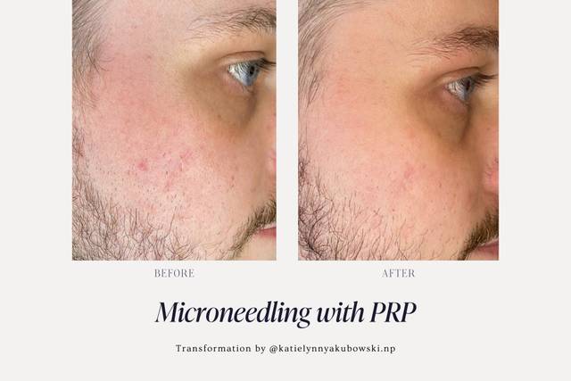 Microneedling B&A