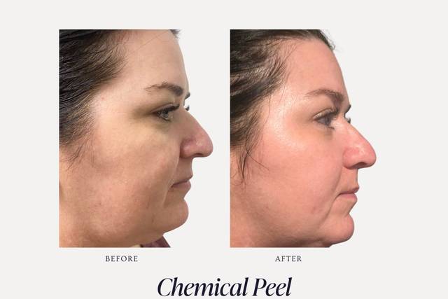 Chemical Peel B&A