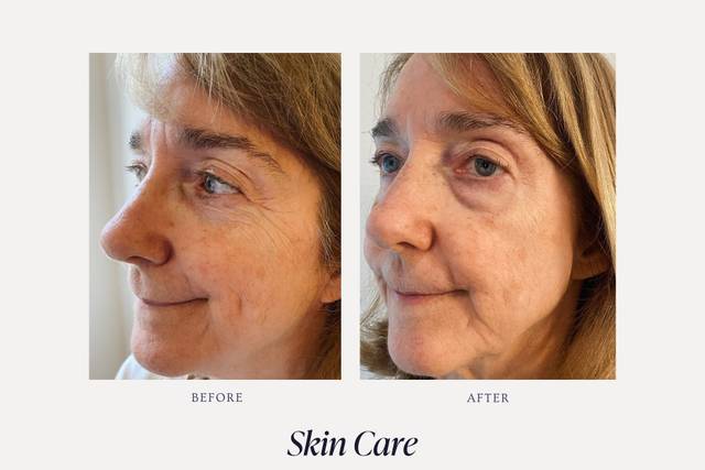 12 months Skincare B&A