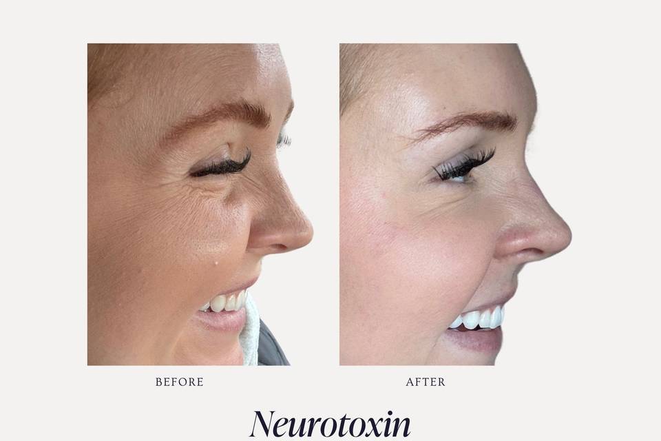 Neurotoxin B&A