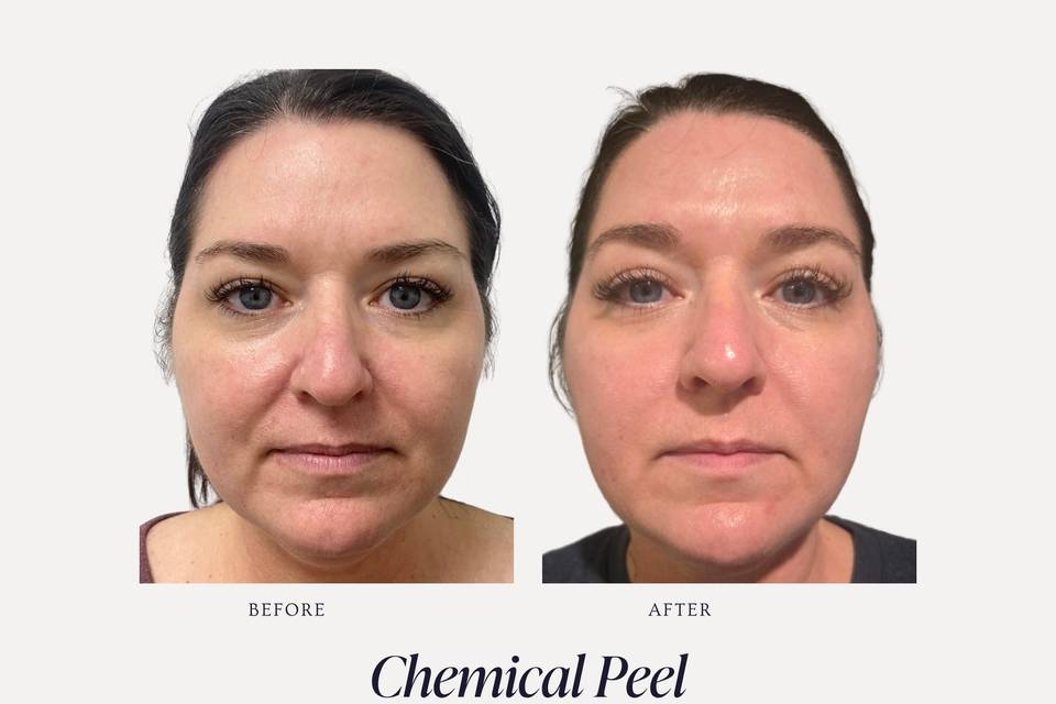 Chemical Peel B&A