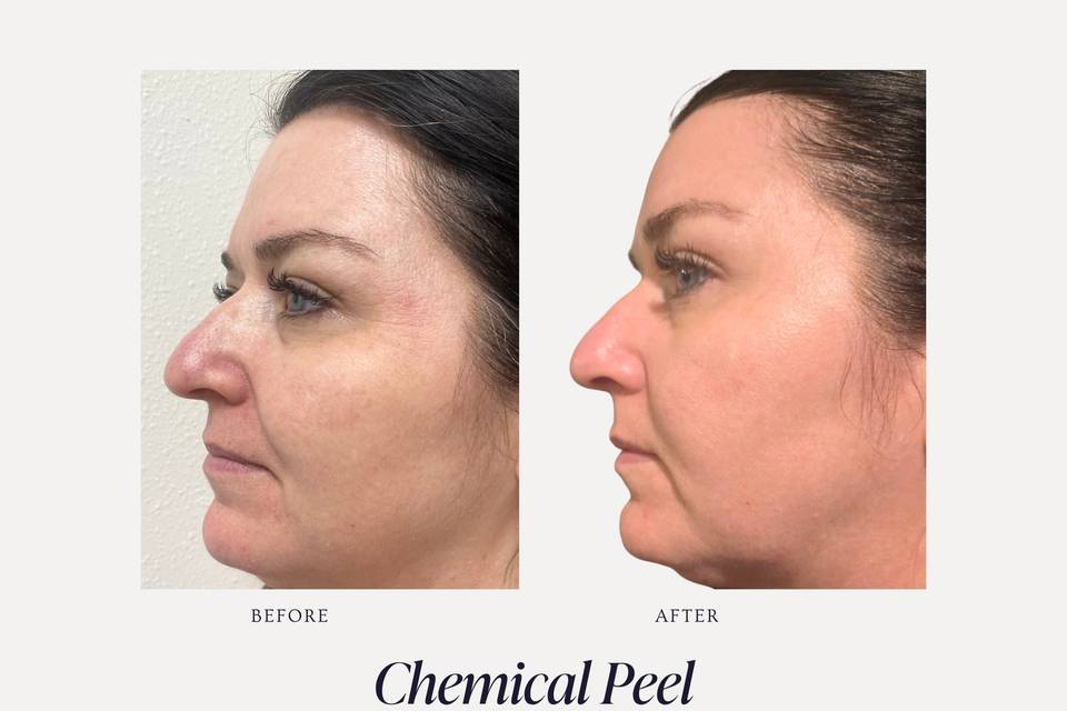 Chemical Peel B&A