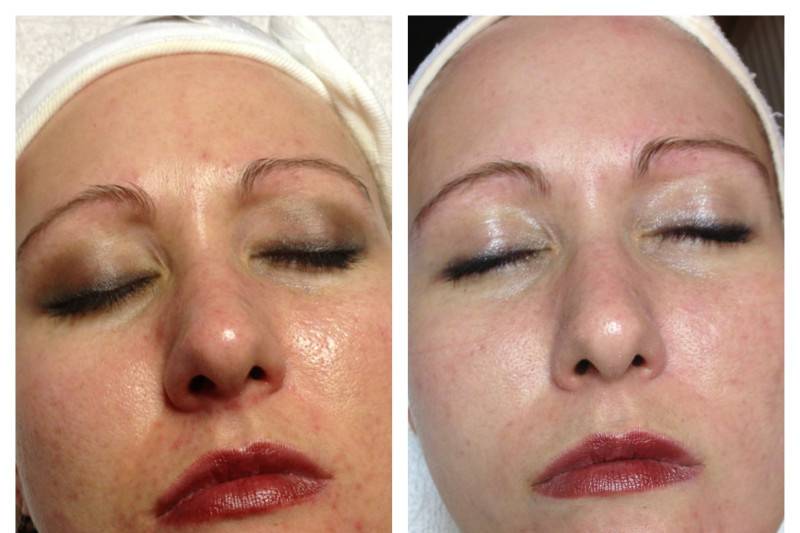 Before and after Chemical Peel treatment