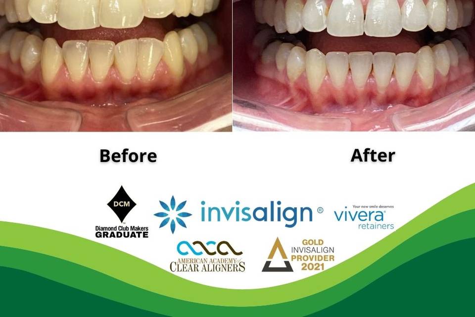 Invisalign