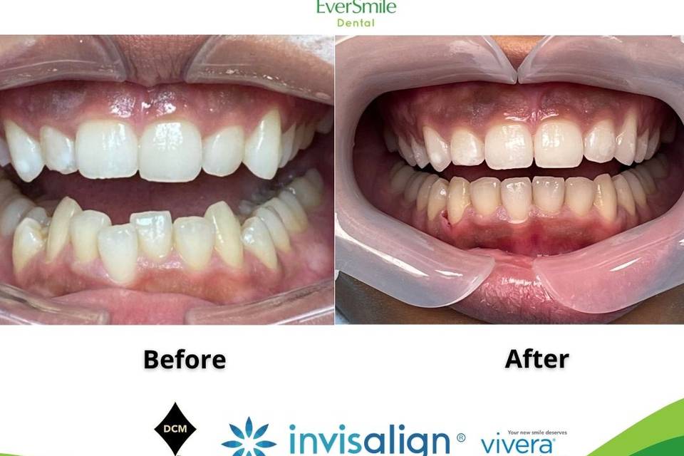 Invisalign