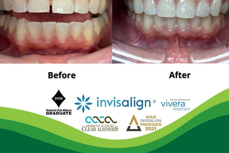 Invisalign