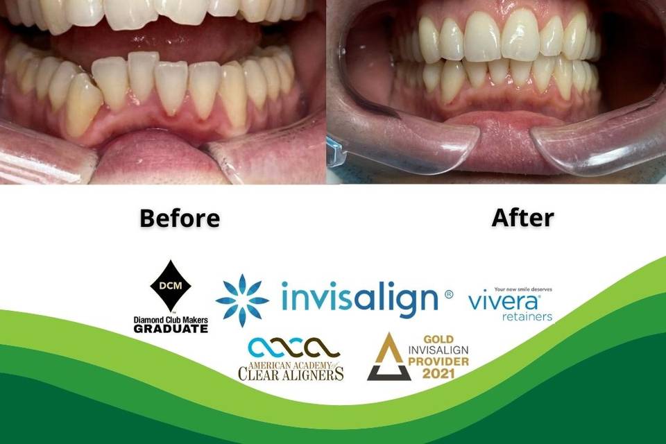 Invisalign