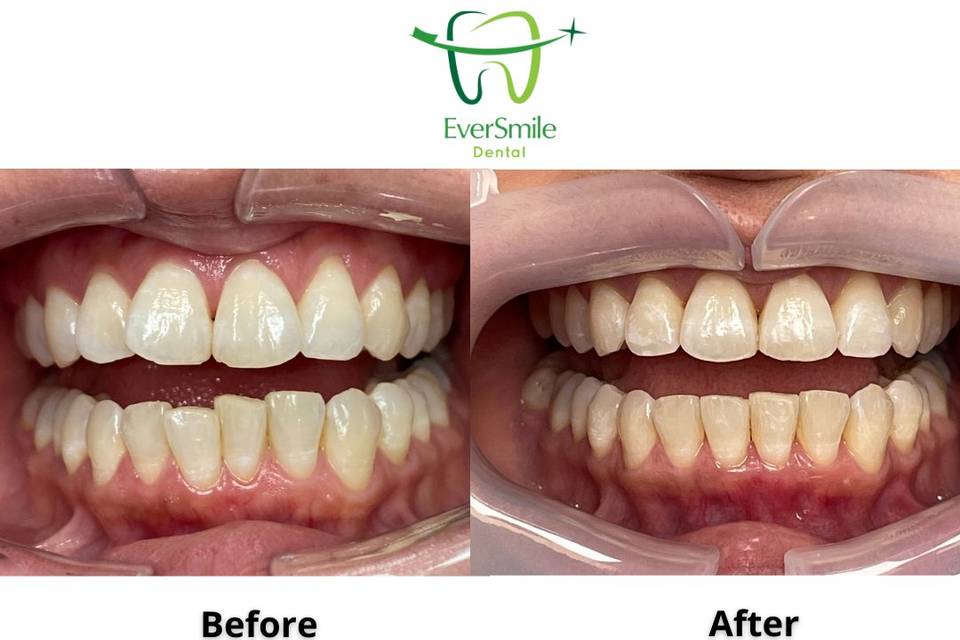 Invisalign