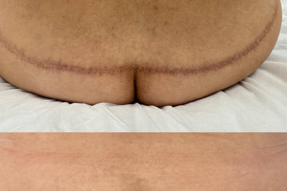 Surgery scar before and after