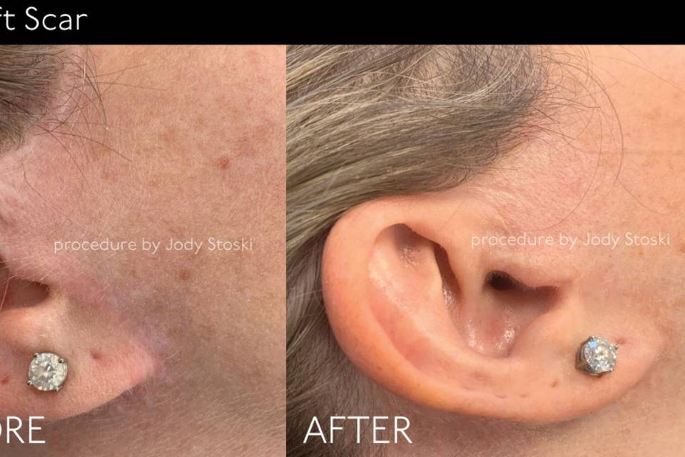 Face lift scar before &after