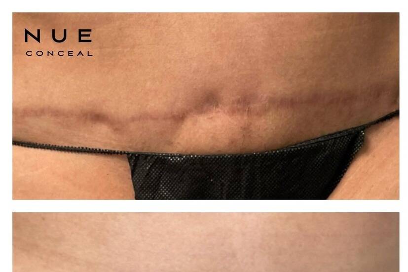 C-section scar before& after