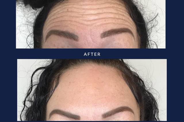 Botox