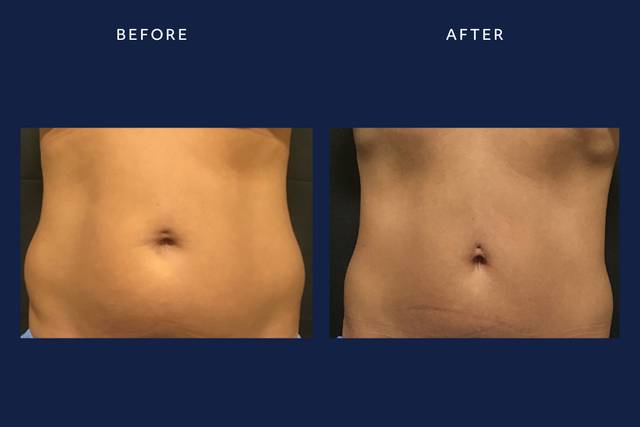 Tummy Tuck for Williamsville & Buffalo, NY