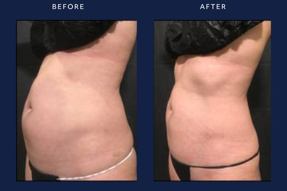 CoolSculpting