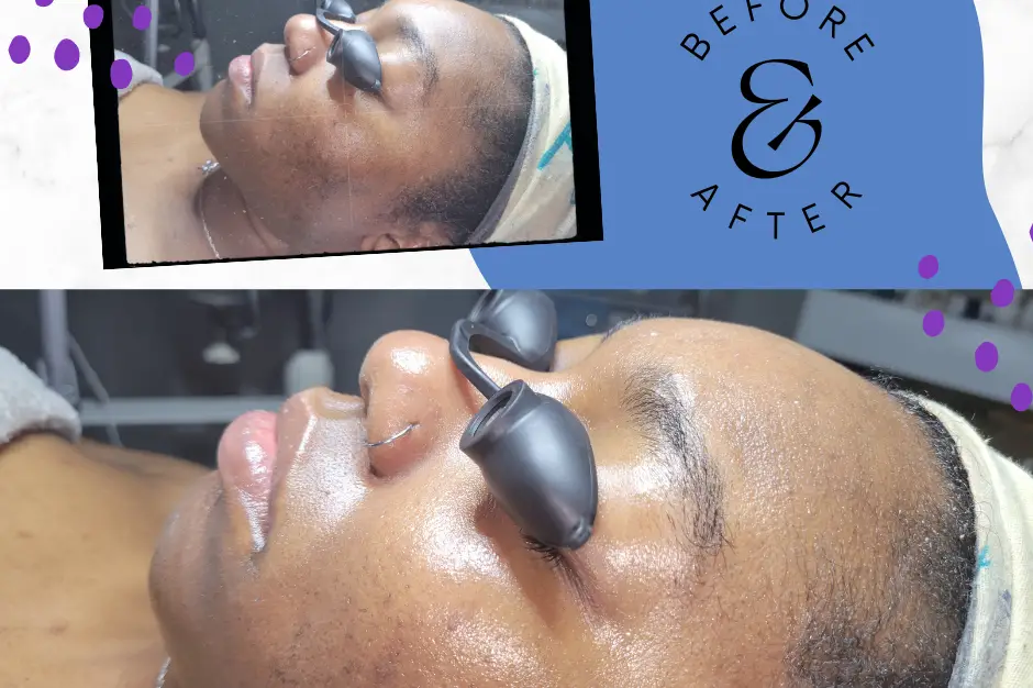 About chemical peels  Studio 824 Beauty Lounge