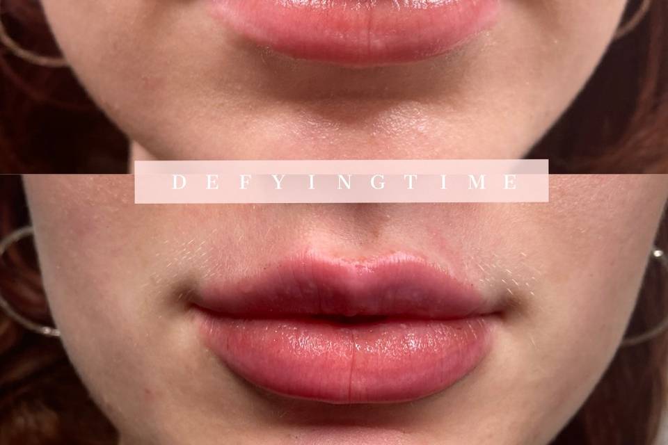 Lip filler before/after