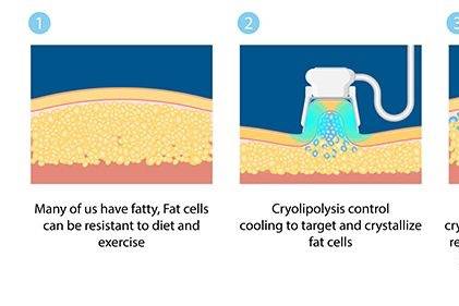 Coolsculpting