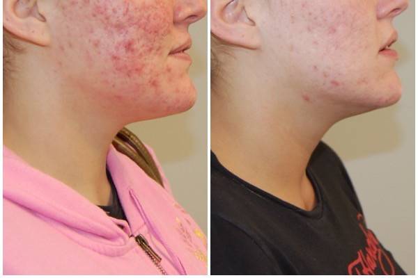 Specializing in Acne Treatments, when you come to us for acne treatment, our aestheticians will work with you to:
– Evaluate your skin
– Work to determine the source of your acne
– Come up with ways to eliminate acne triggers
– Treat your current case of acne using the most effective options at our disposal