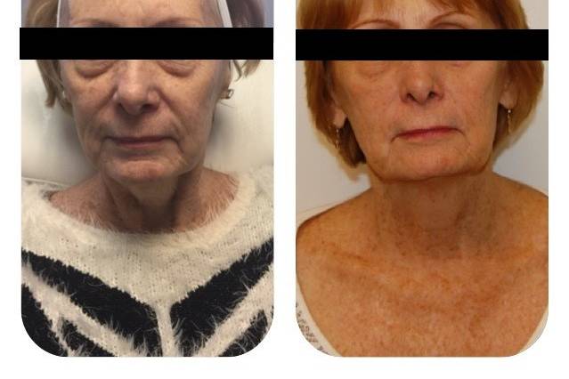 Face Sculpting Treatment, also known as the Natural Face Lift. This is client after 6 treatments. Non-Invasive procedure with NO downtime.