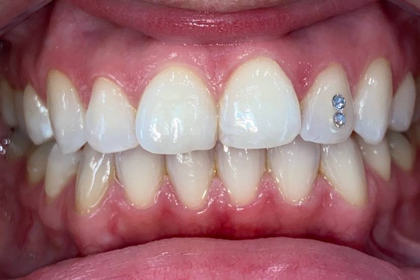 Tooth Gems & Whitening