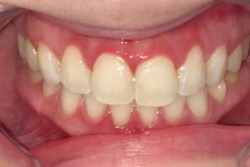 Verletti Beauty Teeth Whitening