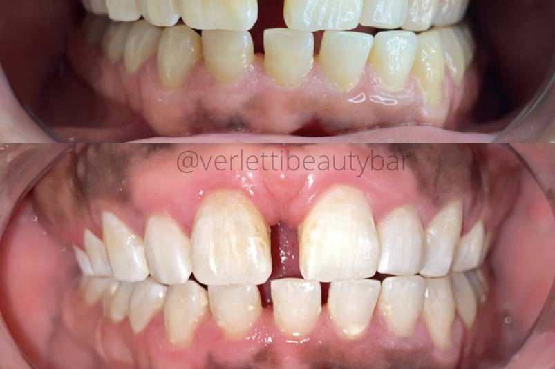 Before & After