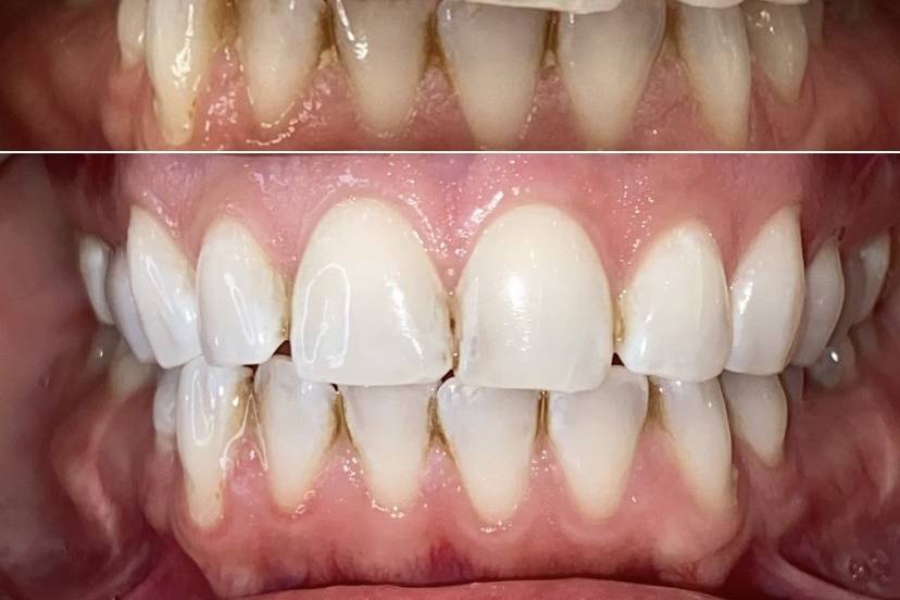 Verletti Beauty Teeth Whitening