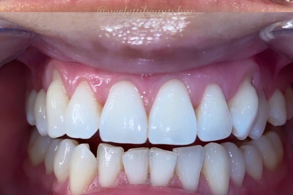 Verletti Beauty Teeth Whitening