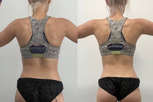 Weight Loss Before & After