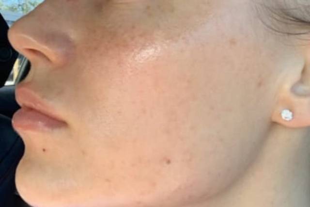 Acne Transformation Results