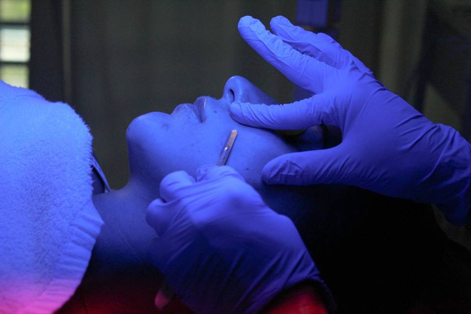 Dermaplaning for unwanted hair