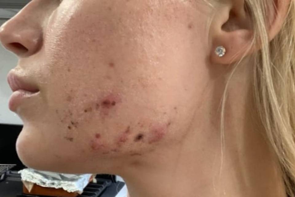 Acne Skin Before Glotique
