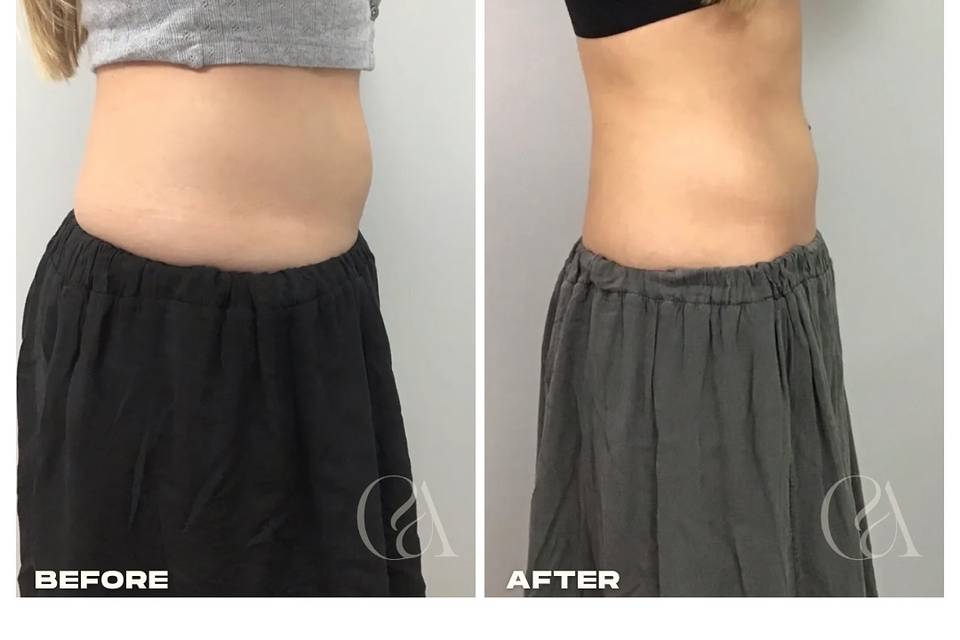 California Body Contouring