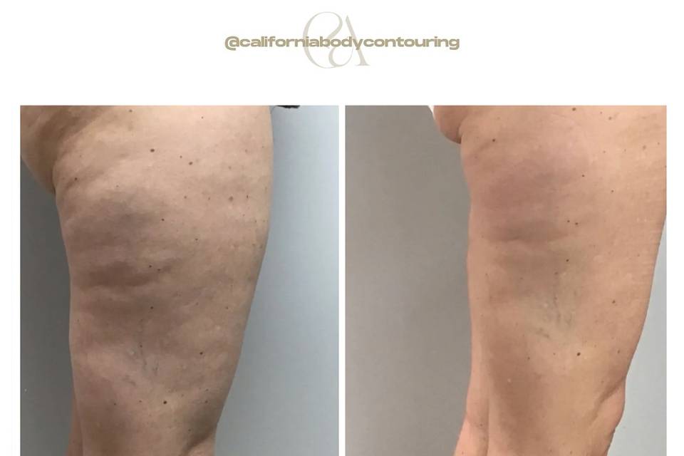 California Body Contouring