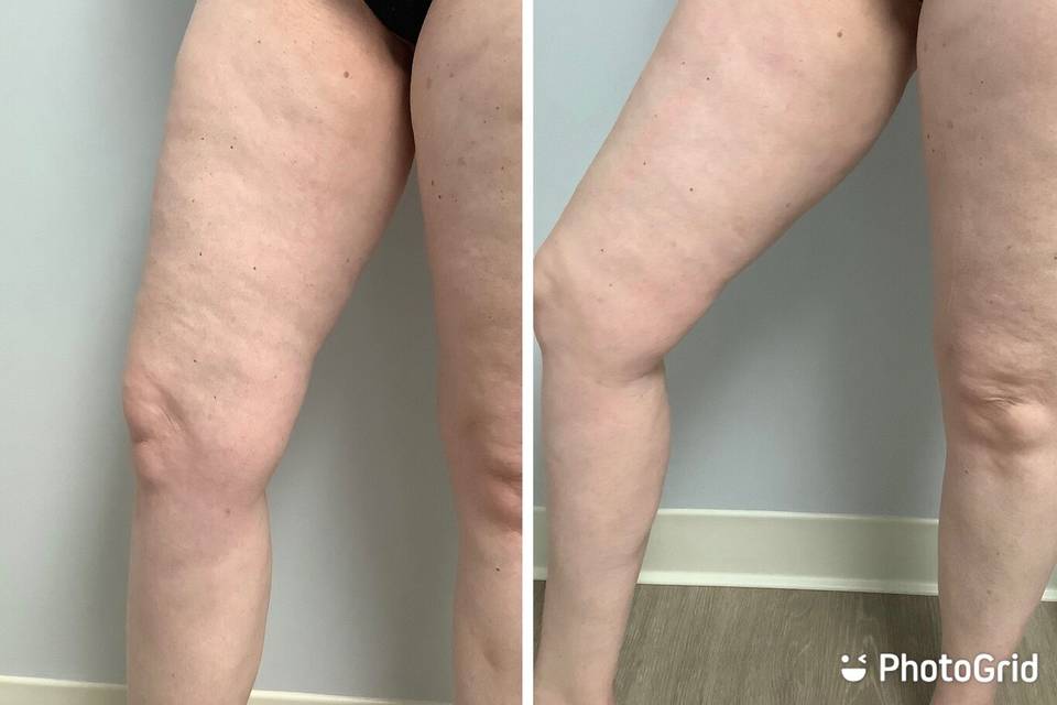 California Body Contouring
